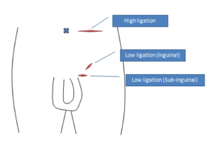 Microsurgical Subinguinal Varicocele Repair. A) Incision sites