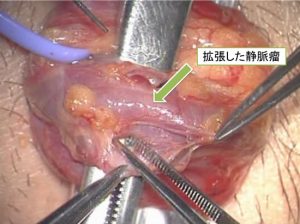 精索静脈瘤に対する顕微鏡下低位結紮術 - 帝京大学泌尿器科アンドロ 